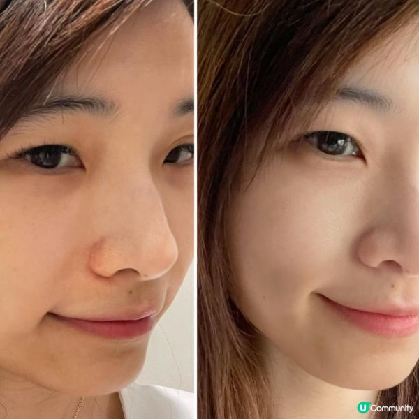 皮膚泛紅急救必備！EMAY PLUS殺痘小飛船