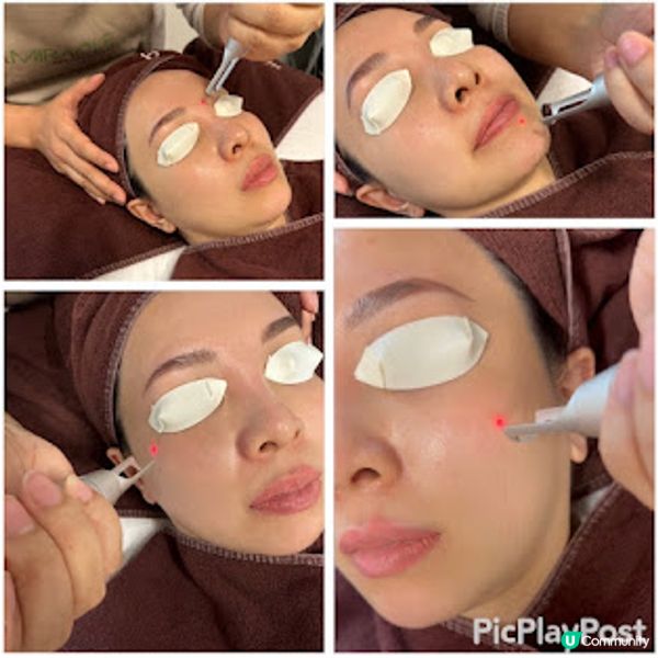 【實測】Dr. Miracle皮秒激光去斑療程效果分享～Dr. Miracle好唔好? 是否黑店?