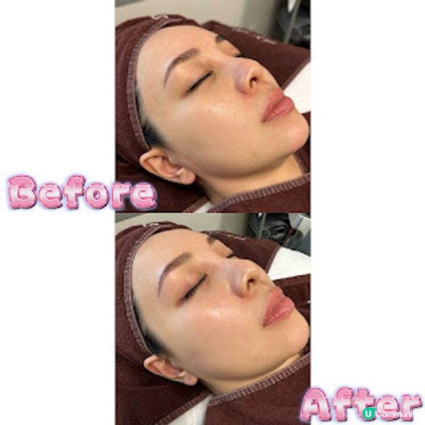 【實測】Dr. Miracle皮秒激光去斑療程效果分享～Dr. Miracle好唔好? 是否黑店?