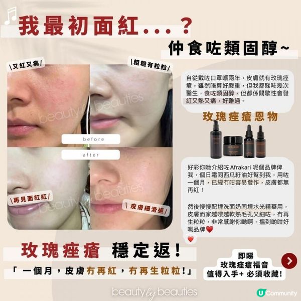 玫瑰痤瘡必用Afrakari南非天然護膚品，一個月戒斷A酸、類固醇