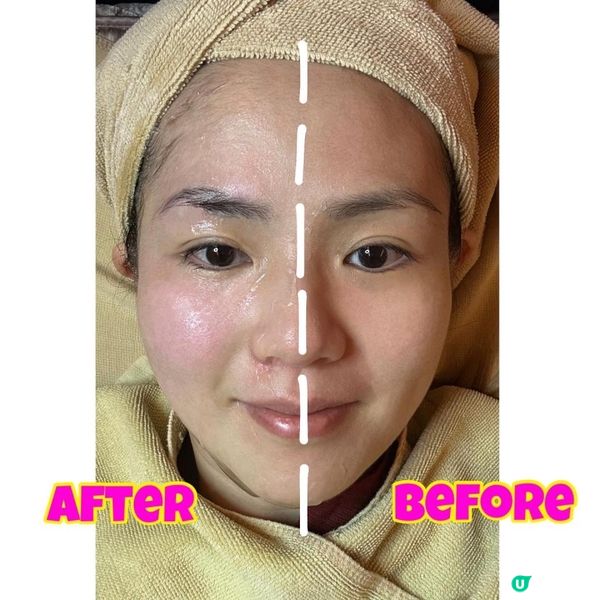 元朗美容院｜BTL超頻膠原眼槍｜新春震撼大優惠