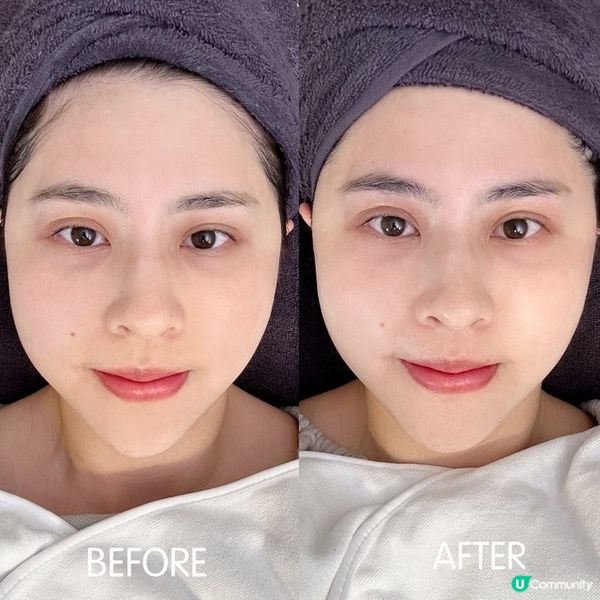 黑眼圈Byebye！ 【AEYE HEALTH】七輪Energy活肌健眼療程【A-EYE Medical】