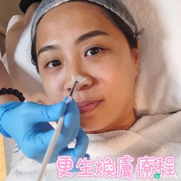 【扮靚推介💆‍♀️】GENE 柔針清痘專家