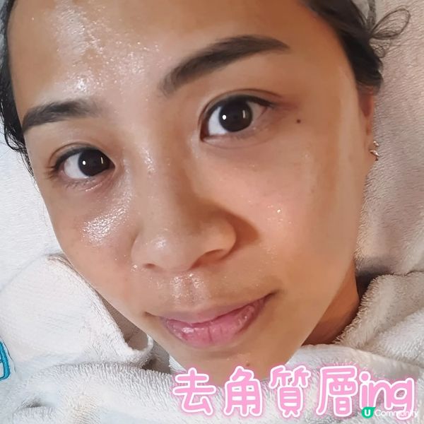 【扮靚推介💆‍♀️】GENE 柔針清痘專家