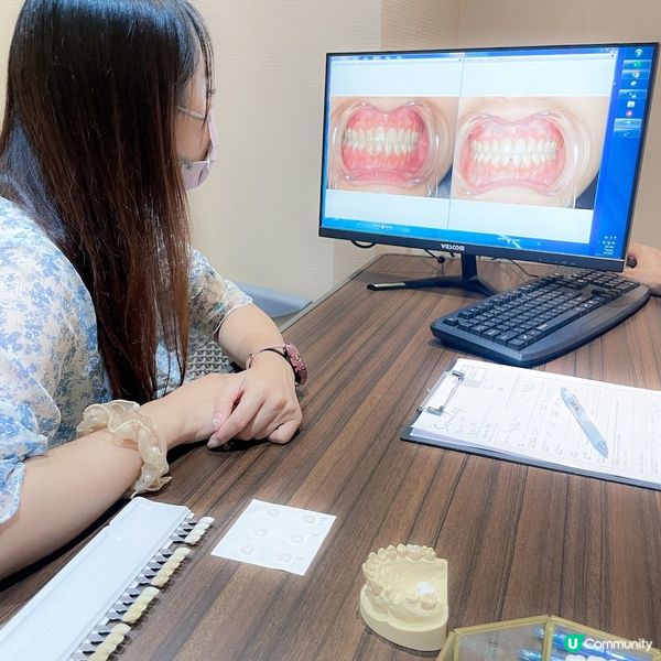 了解全瓷牙貼！擁有亮白笑容！