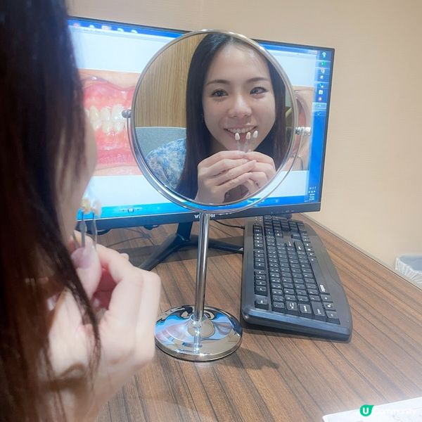 了解全瓷牙貼！擁有亮白笑容！