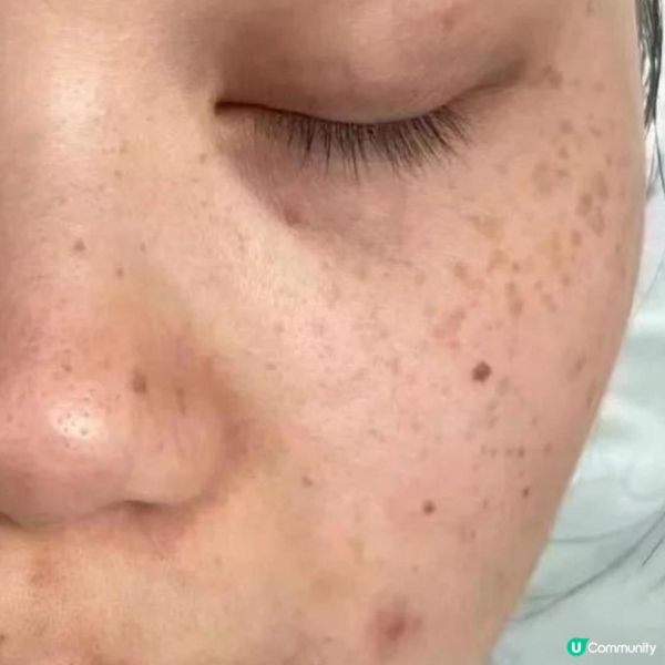 面上有斑點?淺層色斑不容忽視 否則會顯老!一文話你知處理淺層色斑方法