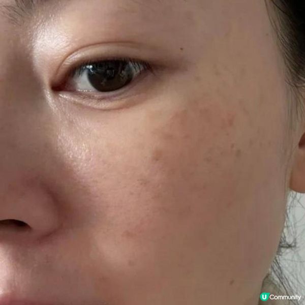 面上有斑點?淺層色斑不容忽視 否則會顯老!一文話你知處理淺層色斑方法