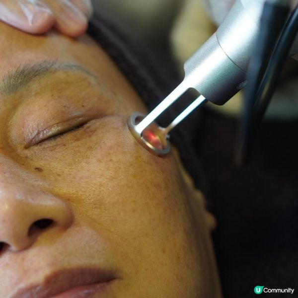 面上有斑點?淺層色斑不容忽視 否則會顯老!一文話你知處理淺層色斑方法