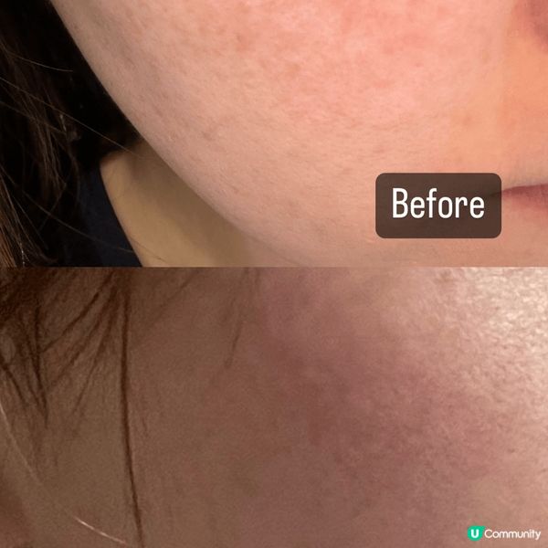 呢兩支美白精華係堅有效！用咗一個月，啲斑淡左好多！真實分享冇...