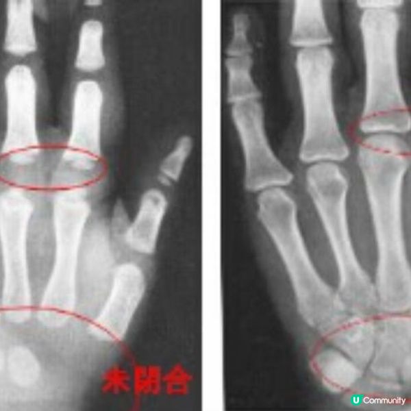 生長板的迷思！成年後仍可長高嗎？