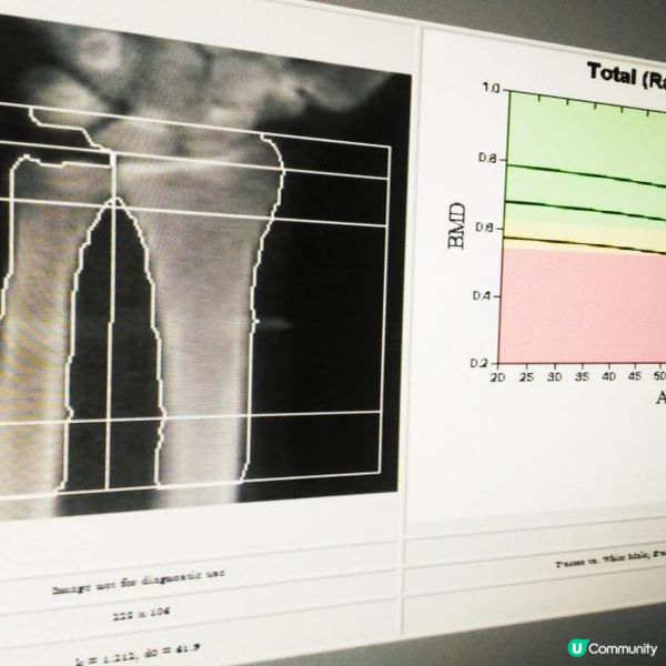 生長板的迷思！成年後仍可長高嗎？