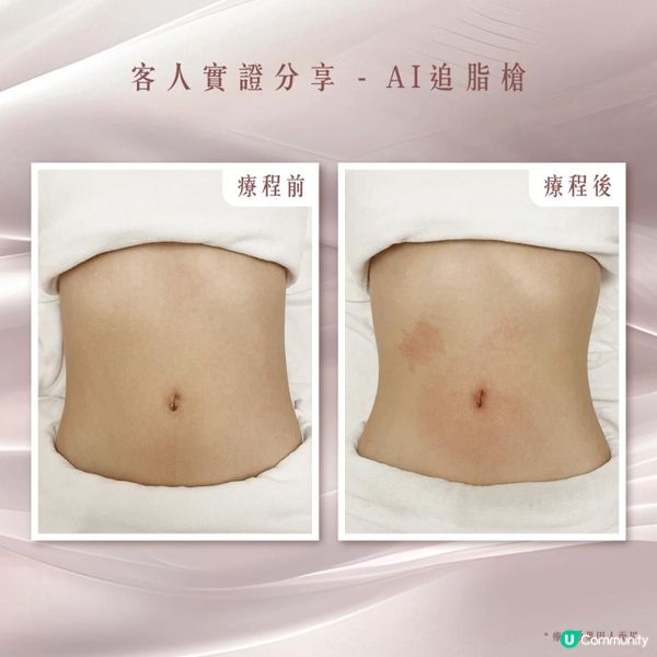 懶人瘦身必睇 NO.1減肥黑科技