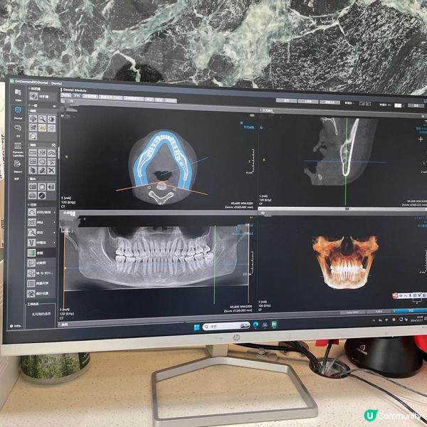 香港人可以去深圳免費洗牙啦‼️‼️