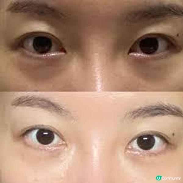 眼部抗老救星：想消除眼袋該選 VITAE白松露眼部療程還是 New Beauty R6包去眼袋療程？熟女公開親身經歷，實測這款更深得人心！