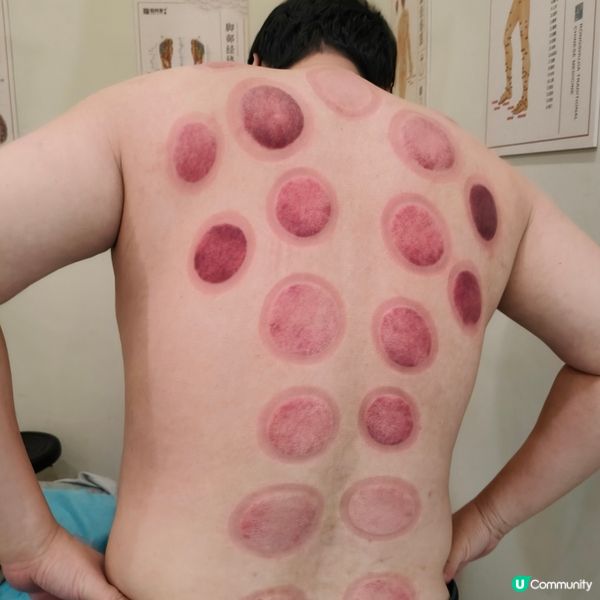 中山之旅，拔罐養生！🔥💪