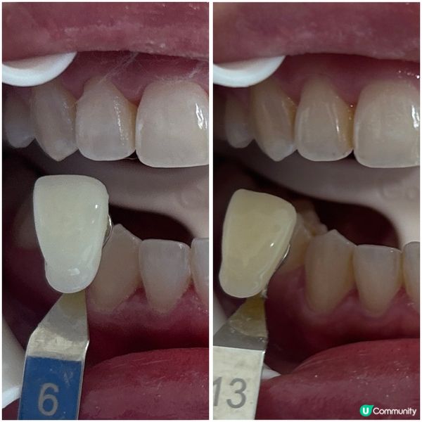 實測去深圳美白牙齒