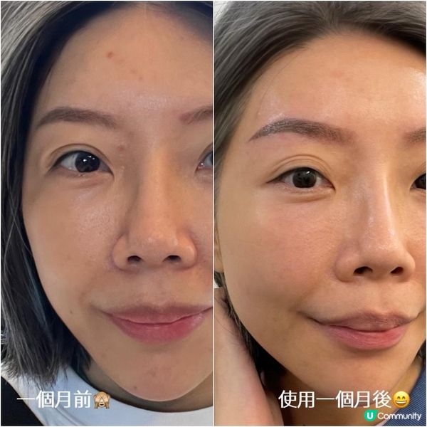 應付中女暗瘡肌膚HAS - Deep Sea系列