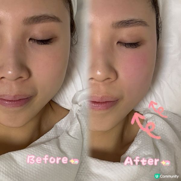 🌟25歲後救星 Ultra Shape R6 膠原槍