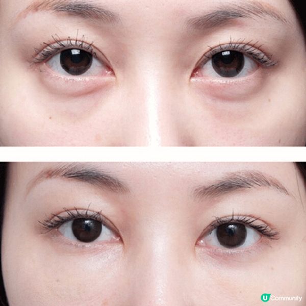 熊貓眼+眼袋超級顯老的組合嚴重拉低顏值！降低視覺年齡的去眼袋服務還得看 INGRID MILLET & New Beauty 的實力！親測這款能在短期內緊緻眼周！