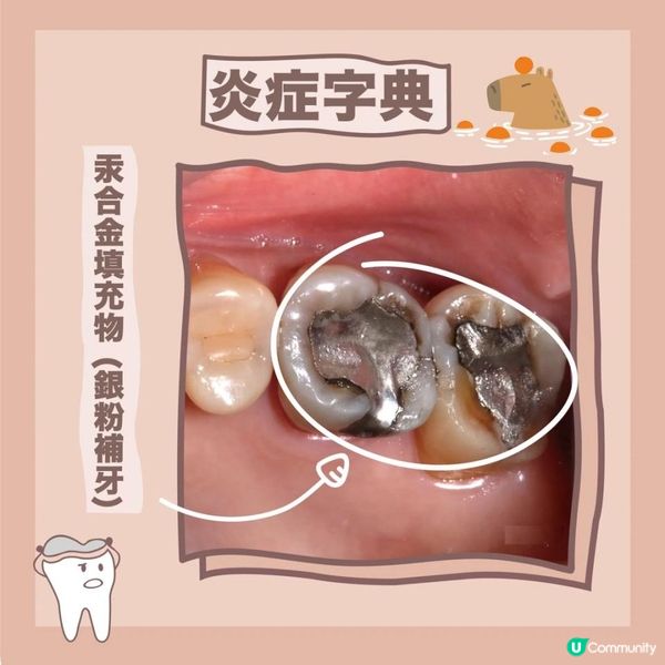【牙醫不敢說的真相】銀粉補牙 🦷
