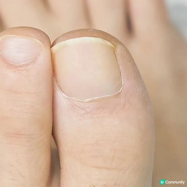 明逸醫療幫我解決3年的灰甲困擾｜康復時間｜激光治療有用嗎？