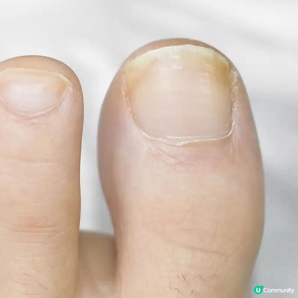 明逸醫療幫我解決3年的灰甲困擾｜康復時間｜激光治療有用嗎？