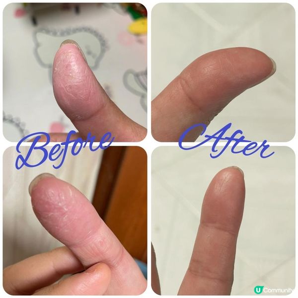 濕疹好用救星！