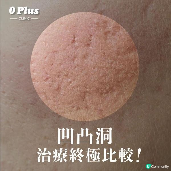 凹凸洞治療終極指南