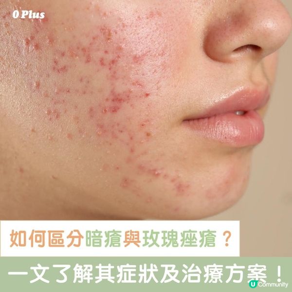 暗瘡與玫瑰痤瘡的區別：症狀、成因與治療全解析