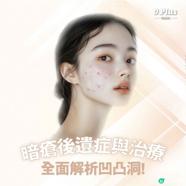 暗瘡後遺症與治療：凹凸洞與痘疤的全面解析