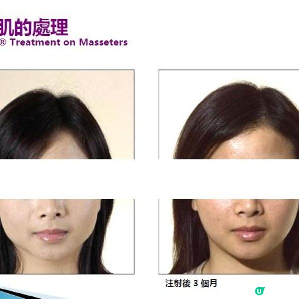 Botox瘦面有咩要注意？