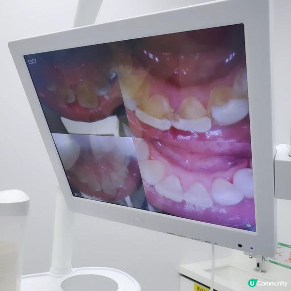 ✨深圳鵬程醫院- 口腔- 深港聯營 洗牙體驗✨