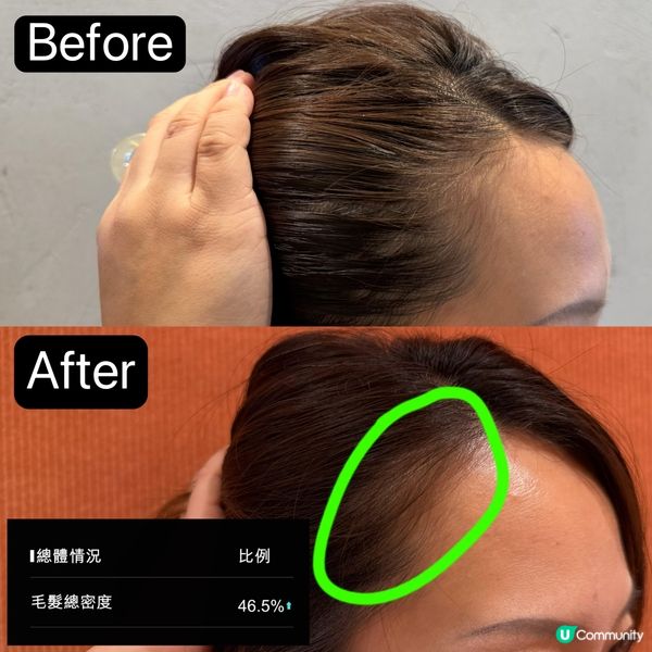 產後脫髮救星！頭髮濃密返晒嚟！🥳