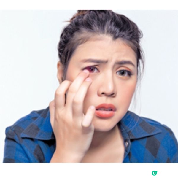 貪靚戴水貨「大眼仔」感染風險高 年輕個案戴Con過夜視力永久