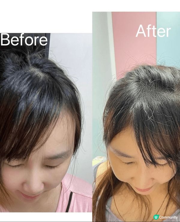 生完兩個小朋友之後，頭髮真係甩多咗好多，每次洗頭和梳頭個陣都...