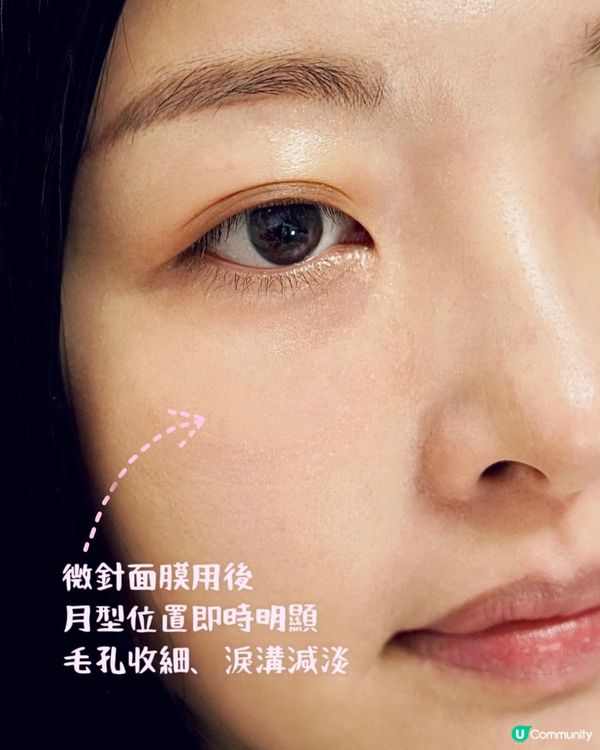 實測大熱家用微針美容🤍最貼近美容院級數