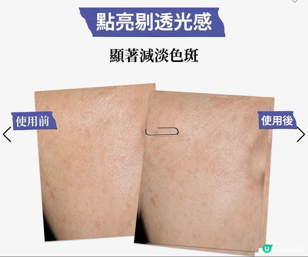 我次次暗瘡完左，都一定用佢，提升肌膚透亮度，重點用係色斑、暗...