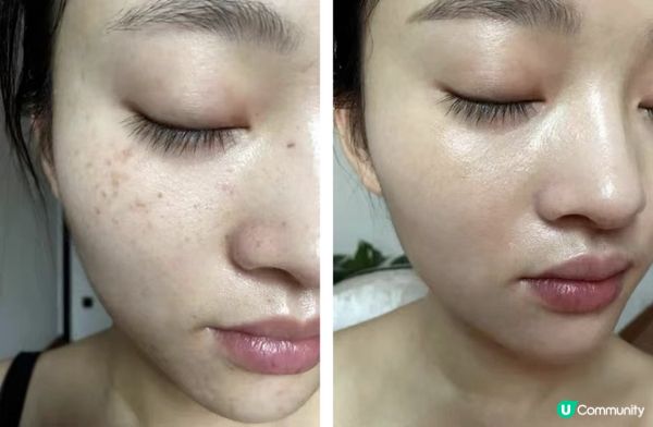正糾結嫩膚祛斑選哪家？分享親測體驗：VITAE VS New Beauty，這款不反黑性價比更高！