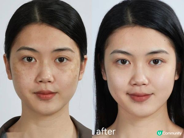 皮秒去斑必痛必留創傷？小資女分享親民價激光服務體驗：NuMe VS Perfect Medical，這款無痛無創，還能在短期內見效！