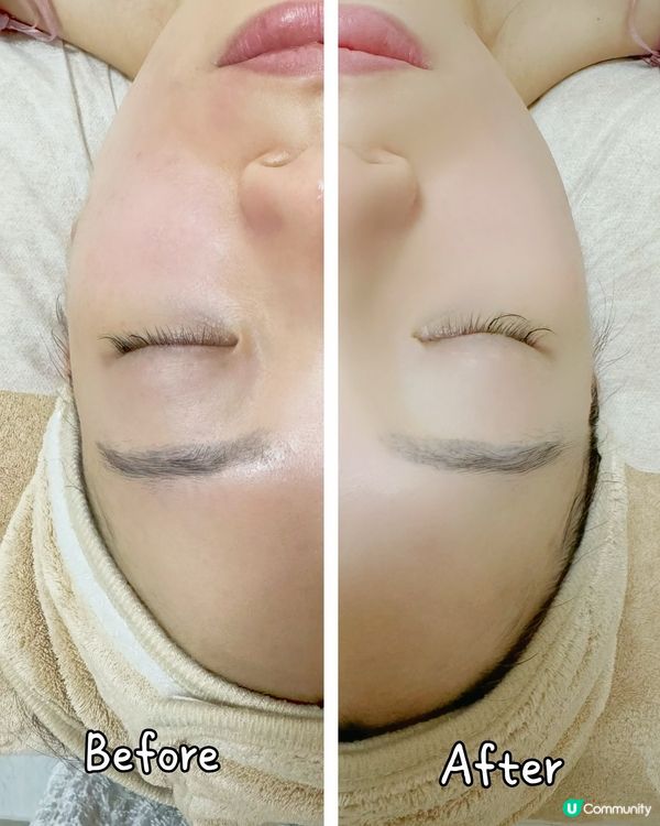 為皮膚開濾鏡✨!Light Filter M22脈衝光💖