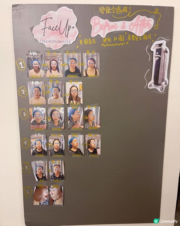 𣊬間逆轉衰老現象既🌟Face Up拉皮抗皺刀🌟真係咁神⁉️