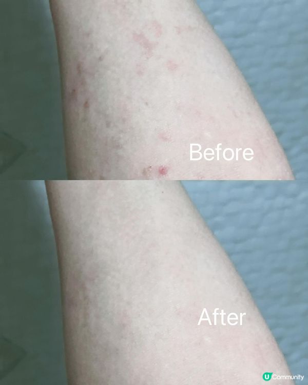 估唔到呢款天然草本產品對抗濕疹真係好有效👍🏻👍🏻