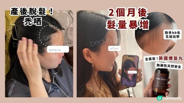 英國Megi Wellness爆髮丸幫我ko產後脫髮！男女都得！地中海、M字額、頭髮稀薄