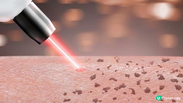 曬出斑？pico4genius皮秒去斑幫我K.O哂啲斑啦！