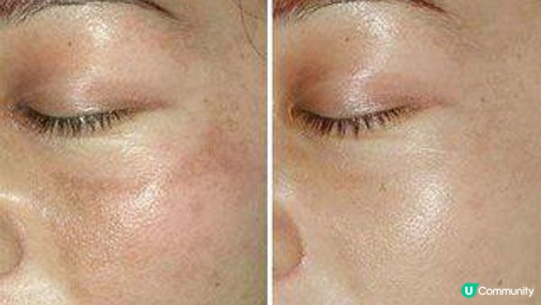 曬出斑？pico4genius皮秒去斑幫我K.O哂啲斑啦！