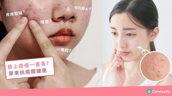 【去暗瘡】改善暗瘡肌不用去美容院！內分泌失調是元凶？