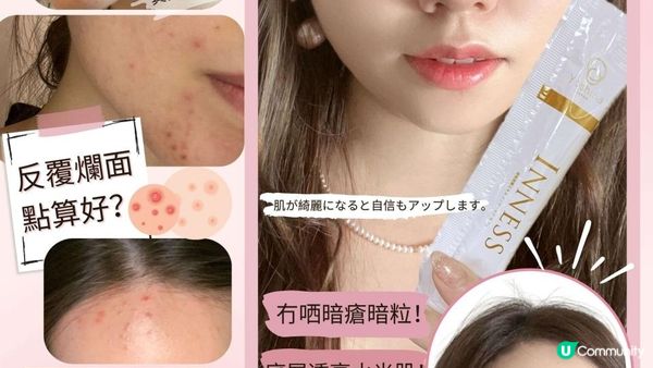 【去暗瘡】改善暗瘡肌不用去美容院！內分泌失調是元凶？