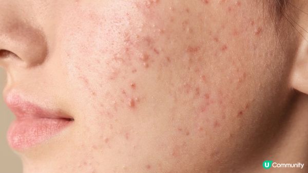 你知道嗎？內分泌失調竟是生暗瘡的頭號元兇！