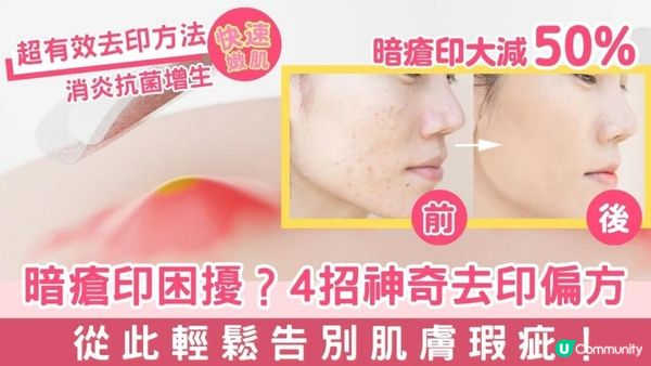 暗瘡困擾？4招神奇去印偏方，輕鬆告別肌膚瑕疵！